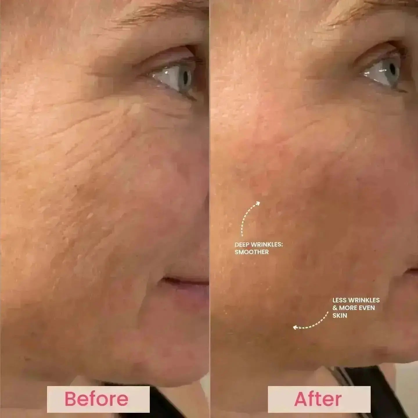 Lumo⁺ + Phoenix: Professional-Grade Skin Tightening and Lifting Duo