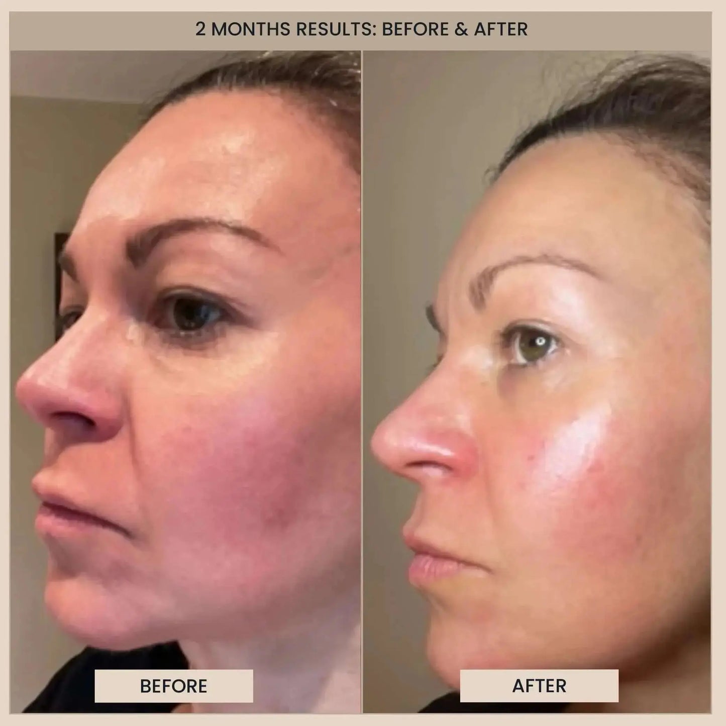 EvenSkyn® Phoenix: Premium Face Lifting Microcurrent Bar