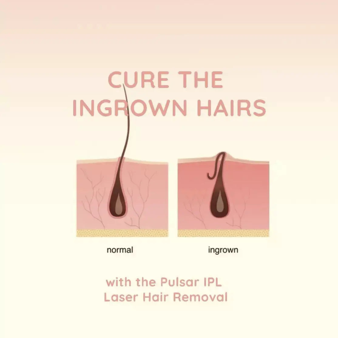 EvenSkyn® Pulsar:At-Home IPL Laser Hair Removal Handset