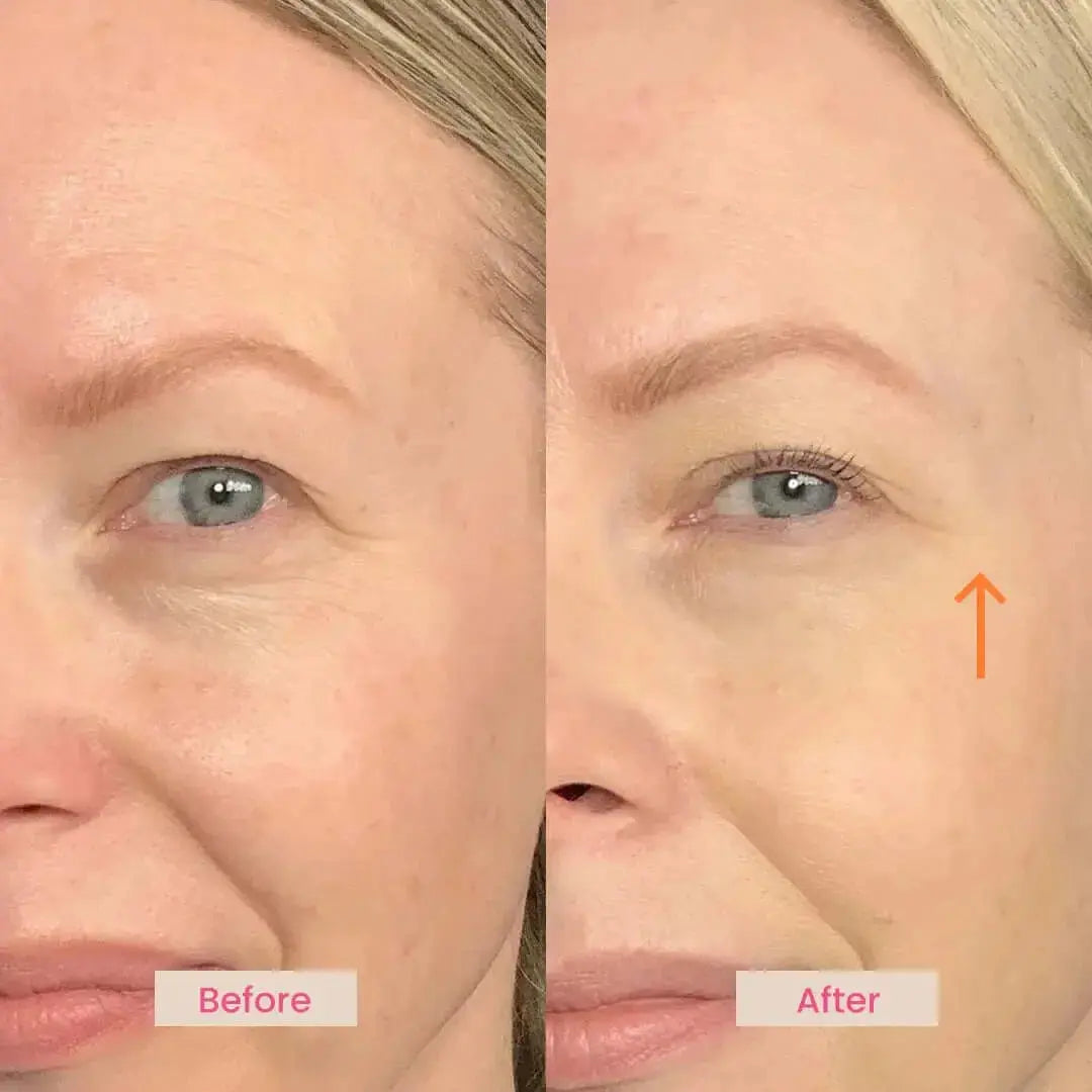 EvenSkyn® Venus: Advanced Eyelid Anti-Aging Device