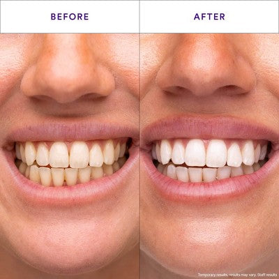 Hismile V34 Teeth Whitening Strips 14pk - Missing Box